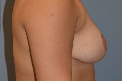 Breast Reduction Before & After Gallery - Patient 350722 - Image 6