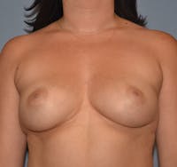 Breast Augmentation Before & After Gallery - Patient 206915 - Image 1