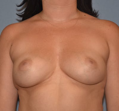 Breast Augmentation Before & After Gallery - Patient 206915 - Image 1