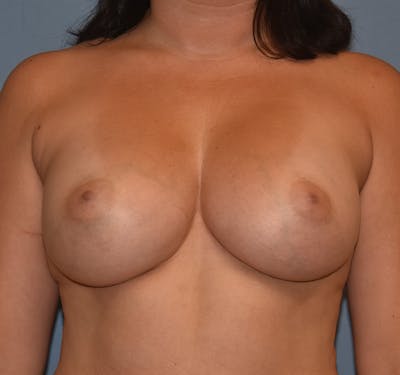 Breast Augmentation Before & After Gallery - Patient 206915 - Image 2