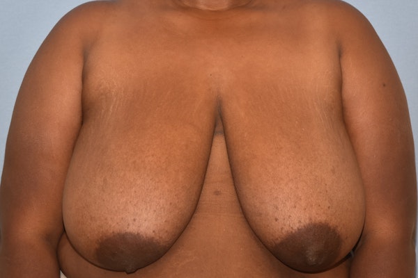 Breast Reduction Before & After Gallery - Patient 420735 - Image 1