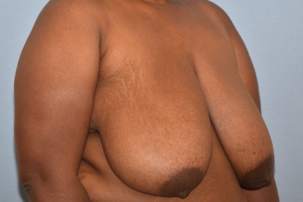 Breast Reduction Before & After Gallery - Patient 420735 - Image 3