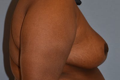 Breast Reduction Before & After Gallery - Patient 420735 - Image 6