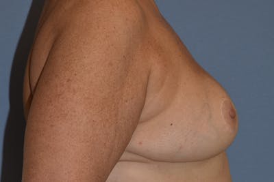 Breast Reduction Before & After Gallery - Patient 250930 - Image 6