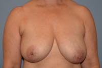 Breast Reduction Before & After Gallery - Patient 415614 - Image 1