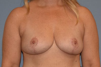 Breast Reduction Before & After Gallery - Patient 415614 - Image 2