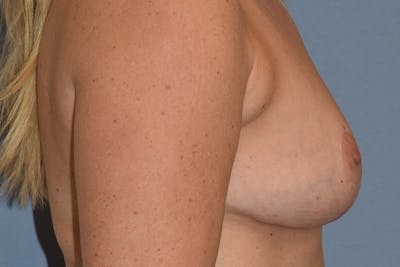 Breast Reduction Before & After Gallery - Patient 415614 - Image 6