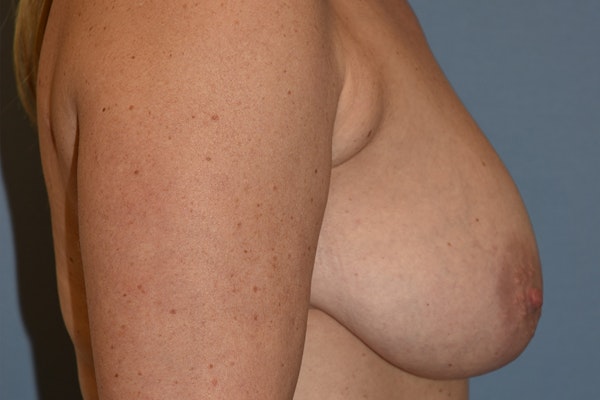 Breast Reduction Before & After Gallery - Patient 415614 - Image 5