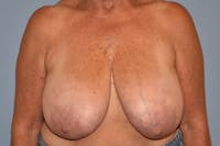 Breast Reduction Before & After Gallery - Patient 533225 - Image 1