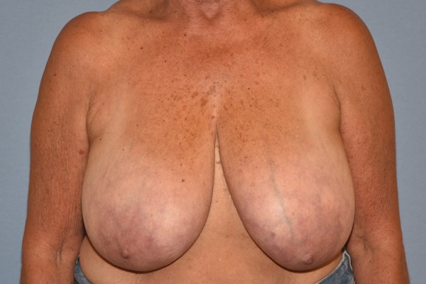 Breast Reduction Before & After Gallery - Patient 533225 - Image 1
