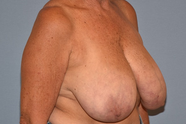 Breast Reduction Before & After Gallery - Patient 533225 - Image 3