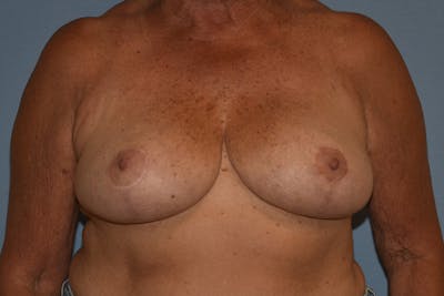 Breast Reduction Before & After Gallery - Patient 533225 - Image 2