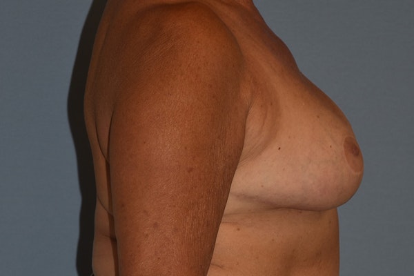 Breast Reduction Before & After Gallery - Patient 533225 - Image 6