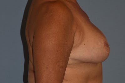Breast Reduction Before & After Gallery - Patient 533225 - Image 6