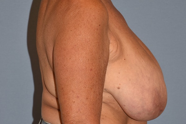 Breast Reduction Before & After Gallery - Patient 533225 - Image 5