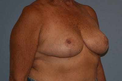 Breast Reduction Before & After Gallery - Patient 533225 - Image 4