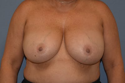 Breast Reduction Before & After Gallery - Patient 402052 - Image 1