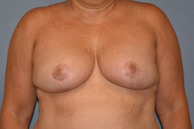 Breast Reduction Before & After Gallery - Patient 402052 - Image 2