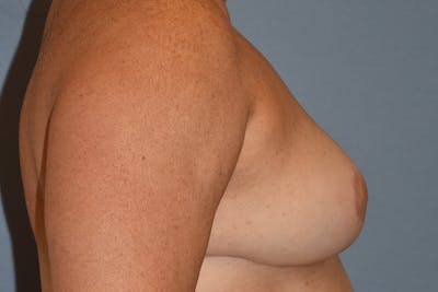 Breast Reduction Before & After Gallery - Patient 402052 - Image 6