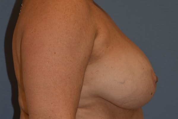 Breast Reduction Before & After Gallery - Patient 402052 - Image 5