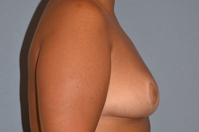 Breast Reduction Before & After Gallery - Patient 348102 - Image 6
