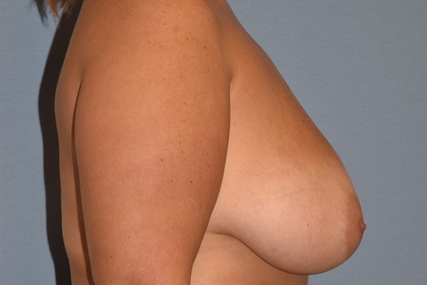 Breast Reduction Before & After Gallery - Patient 348102 - Image 5