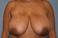 Breast Reduction Before & After Gallery - Patient 396698 - Image 1