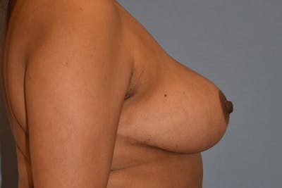 Breast Reduction Before & After Gallery - Patient 396698 - Image 6