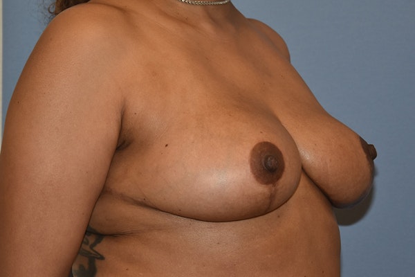 Breast Reduction Before & After Gallery - Patient 396698 - Image 4
