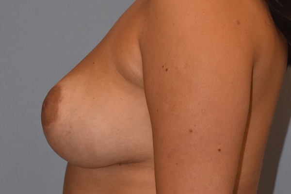Breast Augmentation Lift Before & After Gallery - Patient 234461 - Image 10