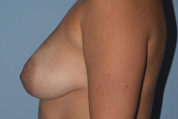 Breast Augmentation Lift Before & After Gallery - Patient 234461 - Image 9
