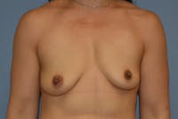 Breast Augmentation Before & After Gallery - Patient 240832 - Image 1