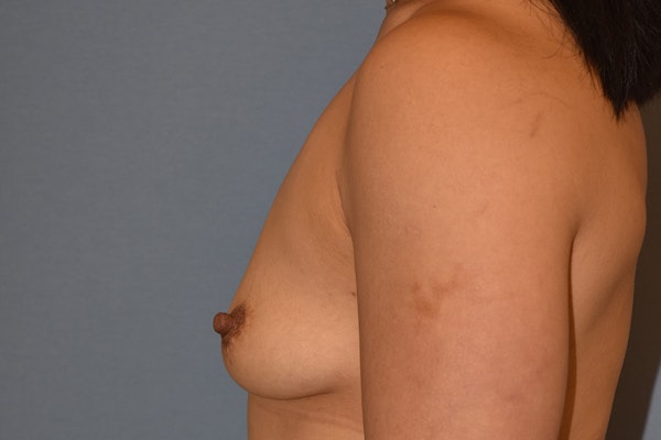 Breast Augmentation Before & After Gallery - Patient 240832 - Image 9