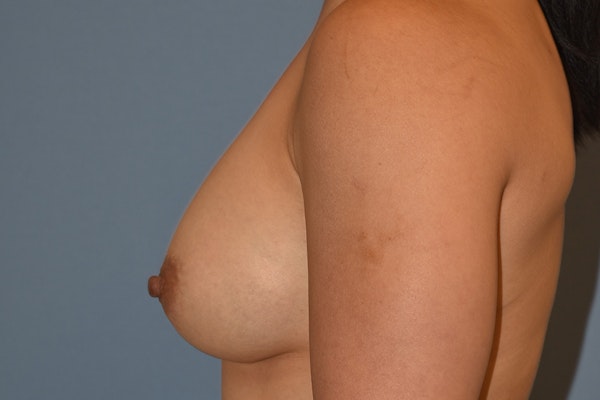 Breast Augmentation Before & After Gallery - Patient 240832 - Image 10