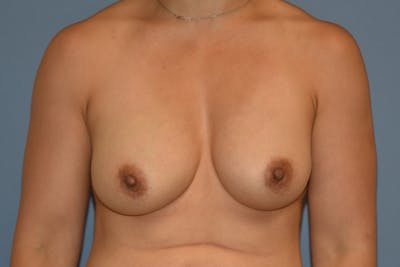 Breast Augmentation Before & After Gallery - Patient 240832 - Image 2