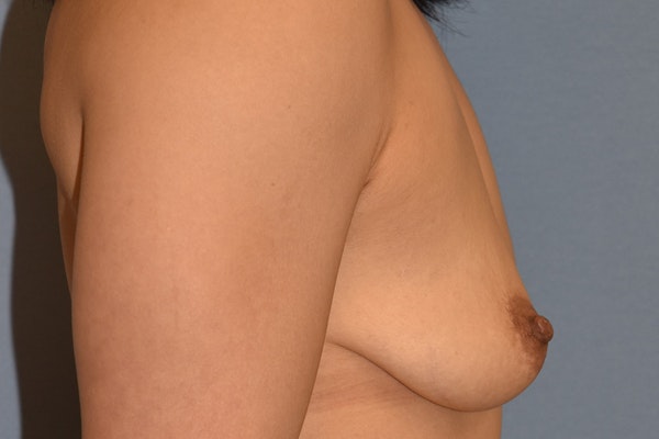 Breast Augmentation Before & After Gallery - Patient 240832 - Image 5