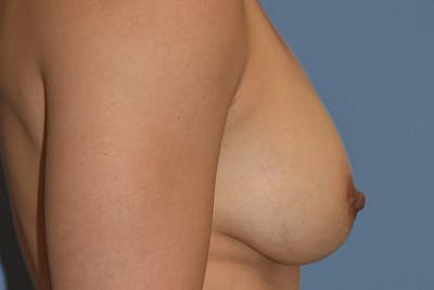 Breast Augmentation Before & After Gallery - Patient 240832 - Image 6