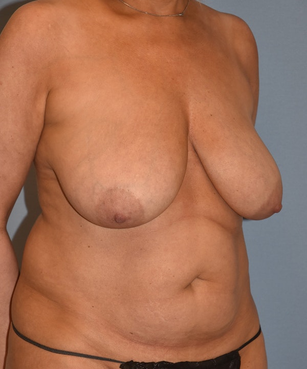 Mommy Makeover Before & After Gallery - Patient 846541 - Image 1