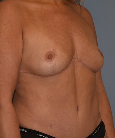Mommy Makeover Before & After Gallery - Patient 846541 - Image 2