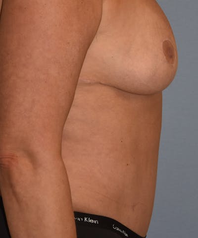 Mommy Makeover Before & After Gallery - Patient 846541 - Image 4