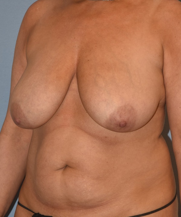 Mommy Makeover Before & After Gallery - Patient 846541 - Image 5