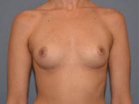 Breast Augmentation Before & After Gallery - Patient 172048 - Image 1