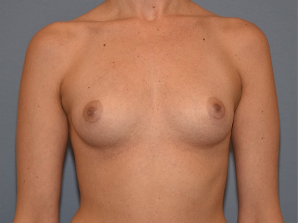 Breast Augmentation Before & After Gallery - Patient 172048 - Image 1