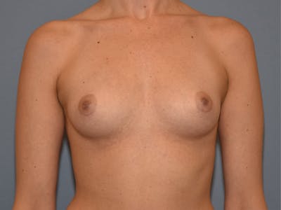 Breast Augmentation Before & After Gallery - Patient 172048 - Image 1