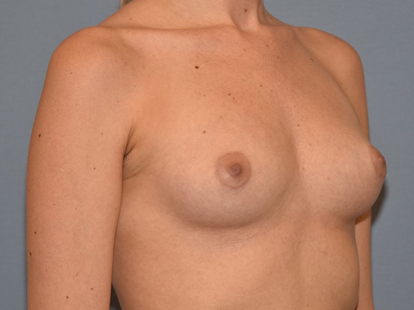 Breast Augmentation Before & After Gallery - Patient 172048 - Image 3