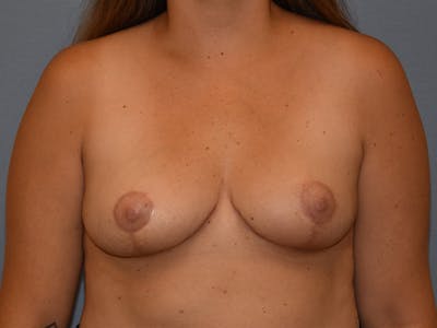 Breast Reduction Before & After Gallery - Patient 489970 - Image 2