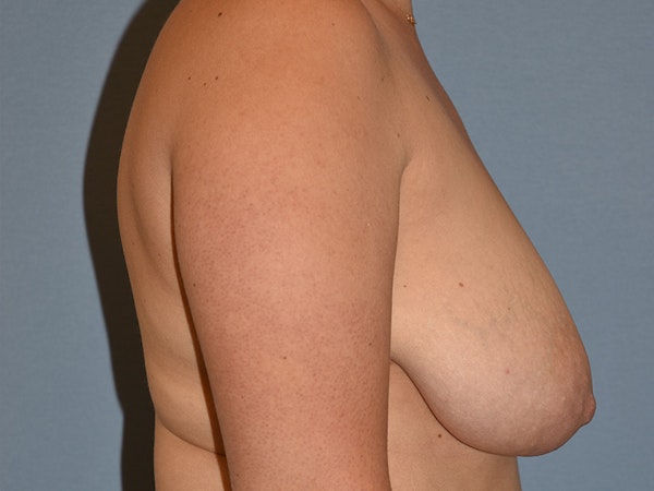 Breast Reduction Before & After Gallery - Patient 489970 - Image 5