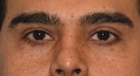 Eyelid Lift Before & After Gallery - Patient 412161 - Image 1