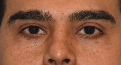 Eyelid Lift Before & After Gallery - Patient 412161 - Image 1