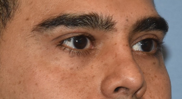 Eyelid Lift Before & After Gallery - Patient 412161 - Image 3